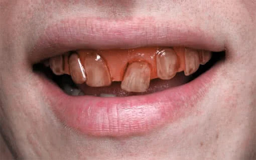 Rotten Goblin SFX Veneer Zähne 1 Rotten Goblin SFX Veneer Zähne